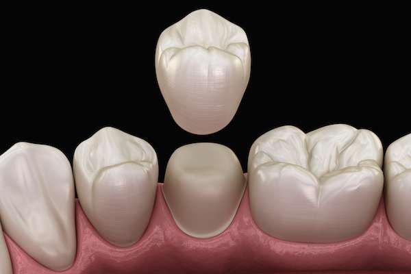 What To Ask Your General Dentist When Preparing for a Crown from Lush Dental Co. in Highland, UT