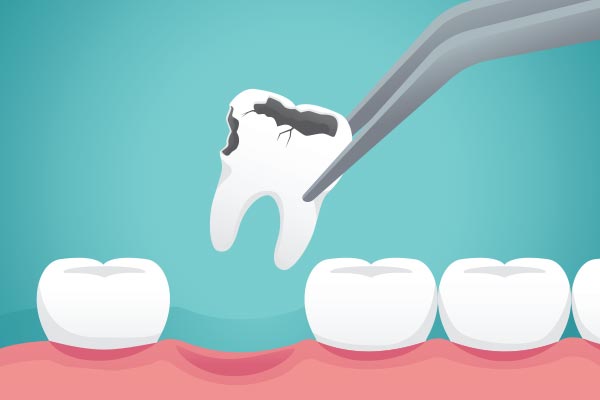 Ask a General Dentist: What Happens to Your Tooth After Extraction from Lush Dental Co. in Highland, UT