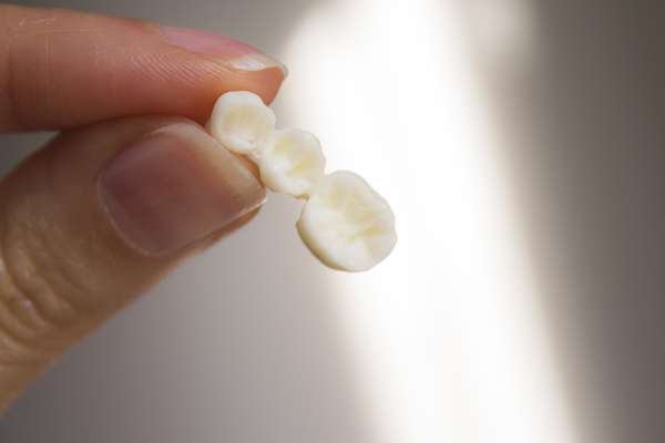 Bridges vs. Dental Implants: Which Is Better from Lush Dental Co. in Highland, UT