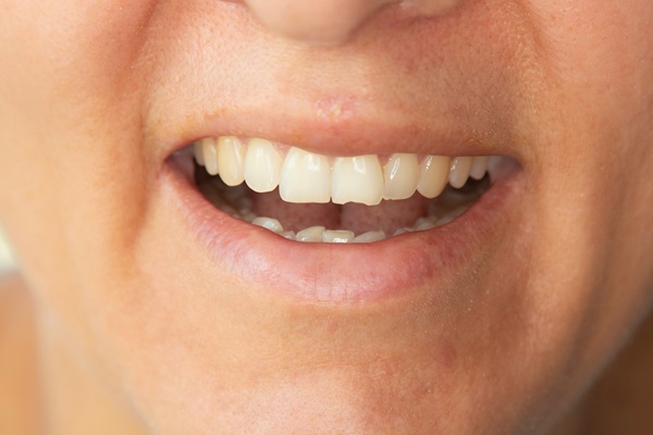 How A Dentist Can Treat A Broken Tooth