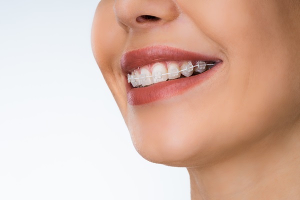 How To Maintain Your Oral Health With Clear Braces From A General Dentist