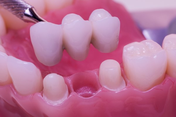 Who Makes A Good Candidate For Dental Bridges?