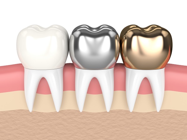 Dental Crowns Highland, UT