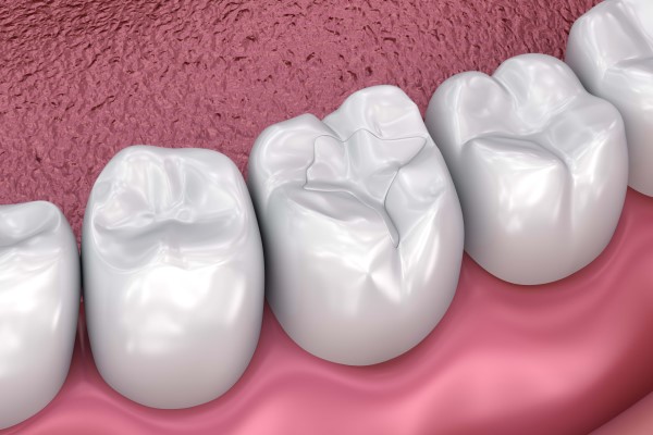 Understanding The Dental Filling Process