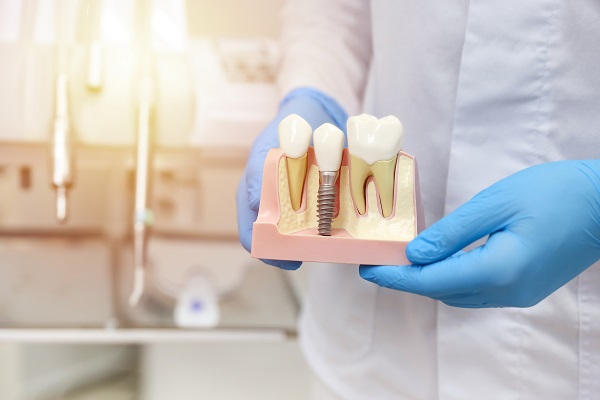 Implant Crown: The Final Step In Restoring Your Smile