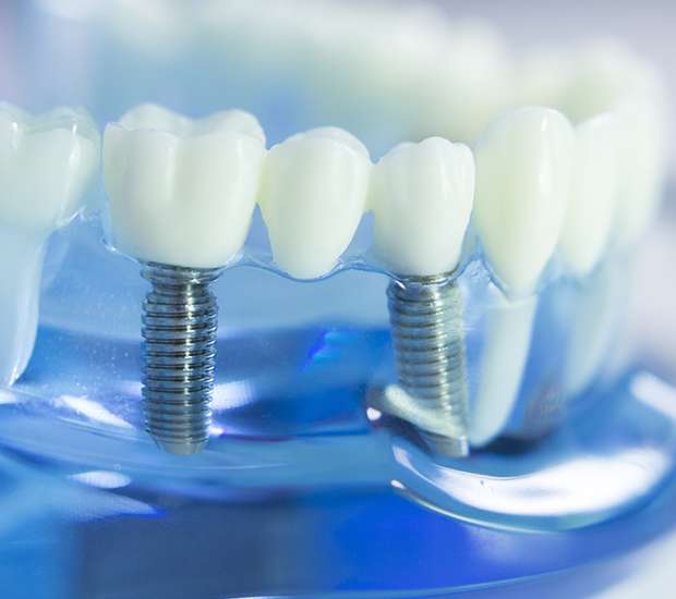 Highland Dental Implants