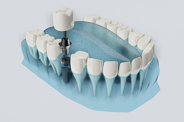 FAQs about Dental Implants from Lush Dental Co. in Highland, UT