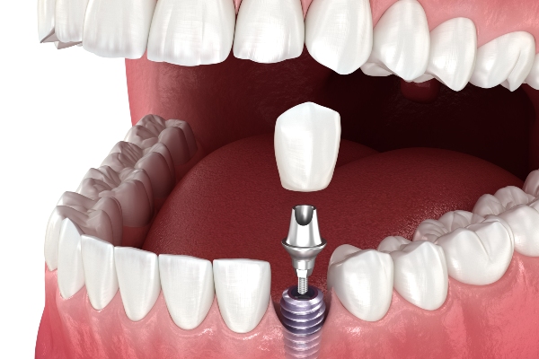 Implant Dentist Vs General Dentist: Who Should You Consult?