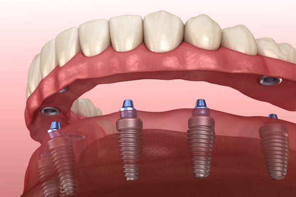 What Full Mouth Dental Implants Are