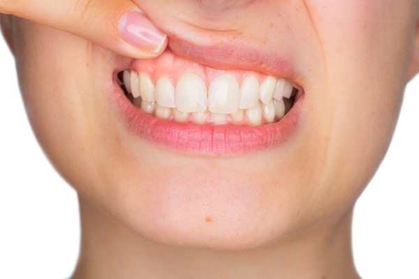 Preventive Dentistry For Receding Gums